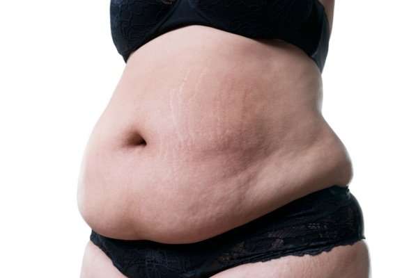 Ideal weight and BMI for abdominoplasty surgery 2 Am I too fat for a Tummy Tuck?
