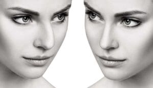 edad minima rinoplastia