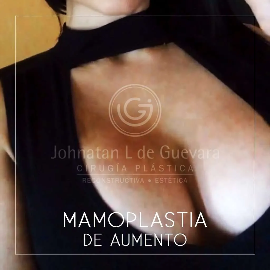 fotos-antes-despues-mamoplastia-colombia-2-1024x1024