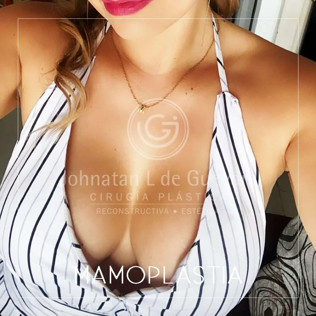 fotos-antes-despues-mamoplastia-colombia-3-1024x1024