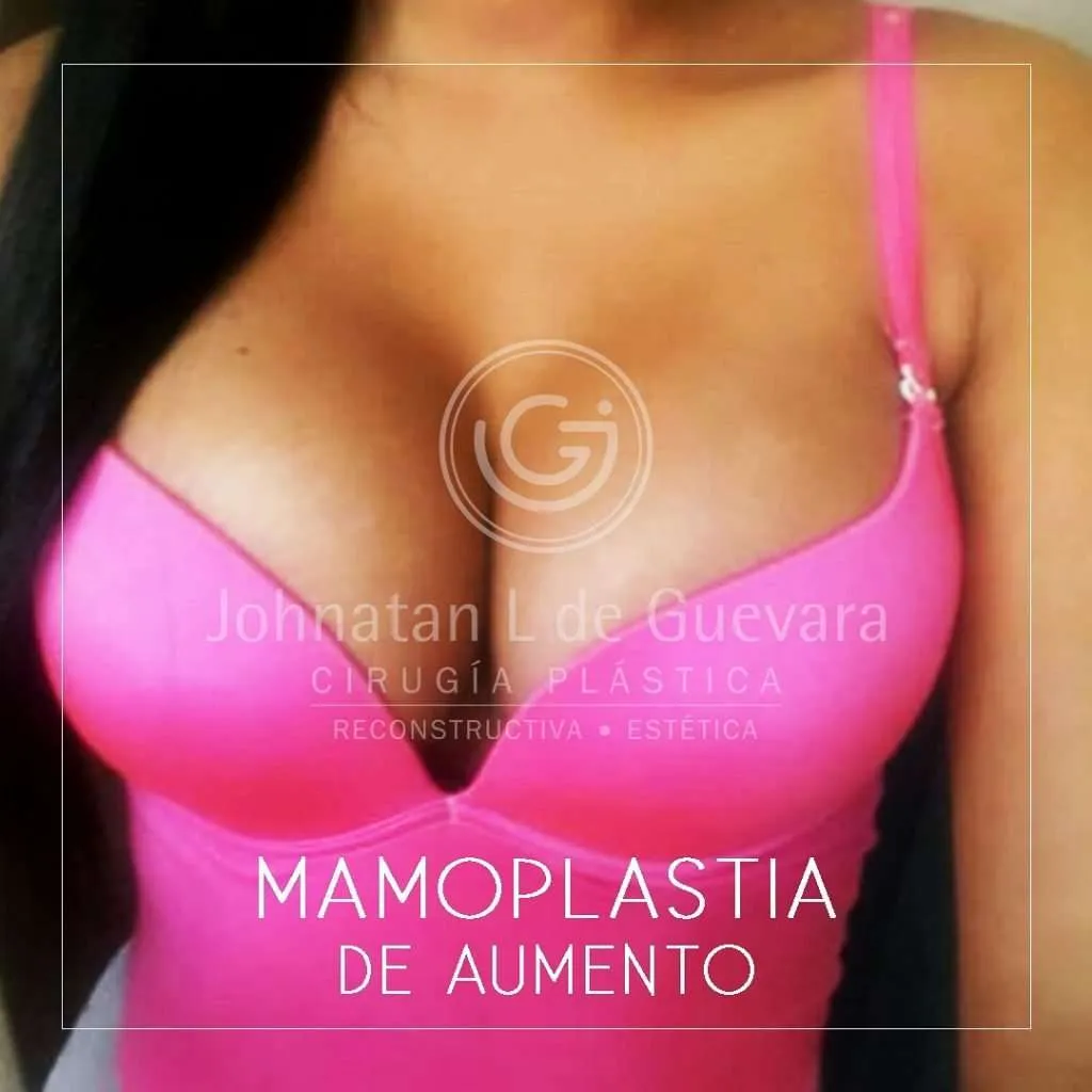 fotos-antes-despues-mamoplastia-colombia-9-1024x1024