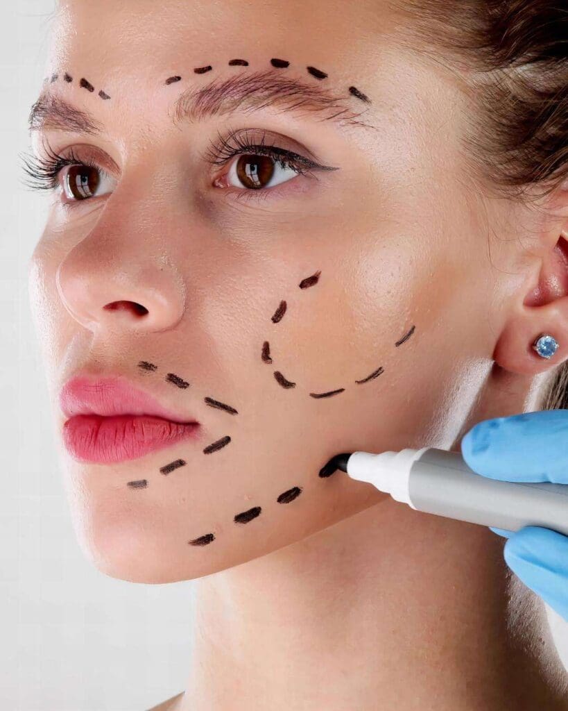 Lifting Facial A - Face Lift Colombia