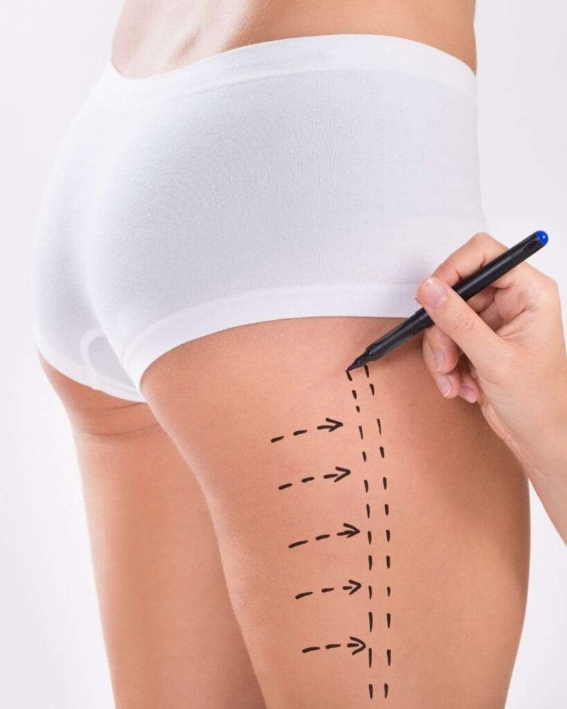 Liposuccion C - All-Inclusive Surgeries in Colombia