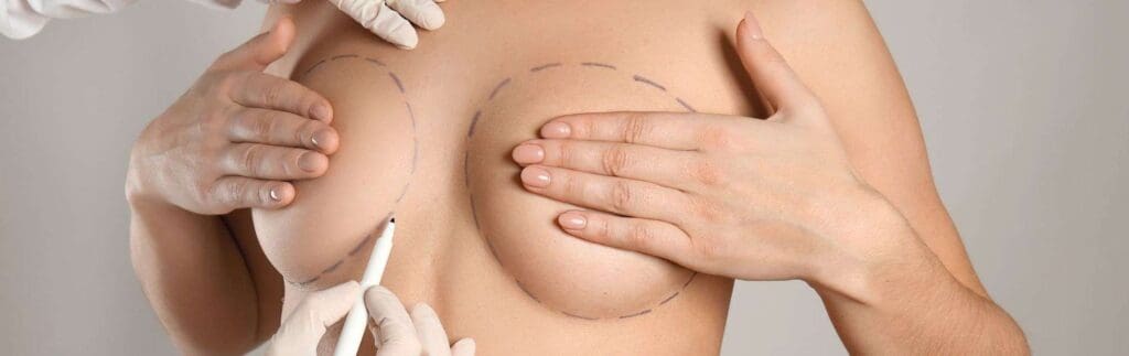 Mamoplastia reduccion E - Mamoplastia de reducción Bogotá
