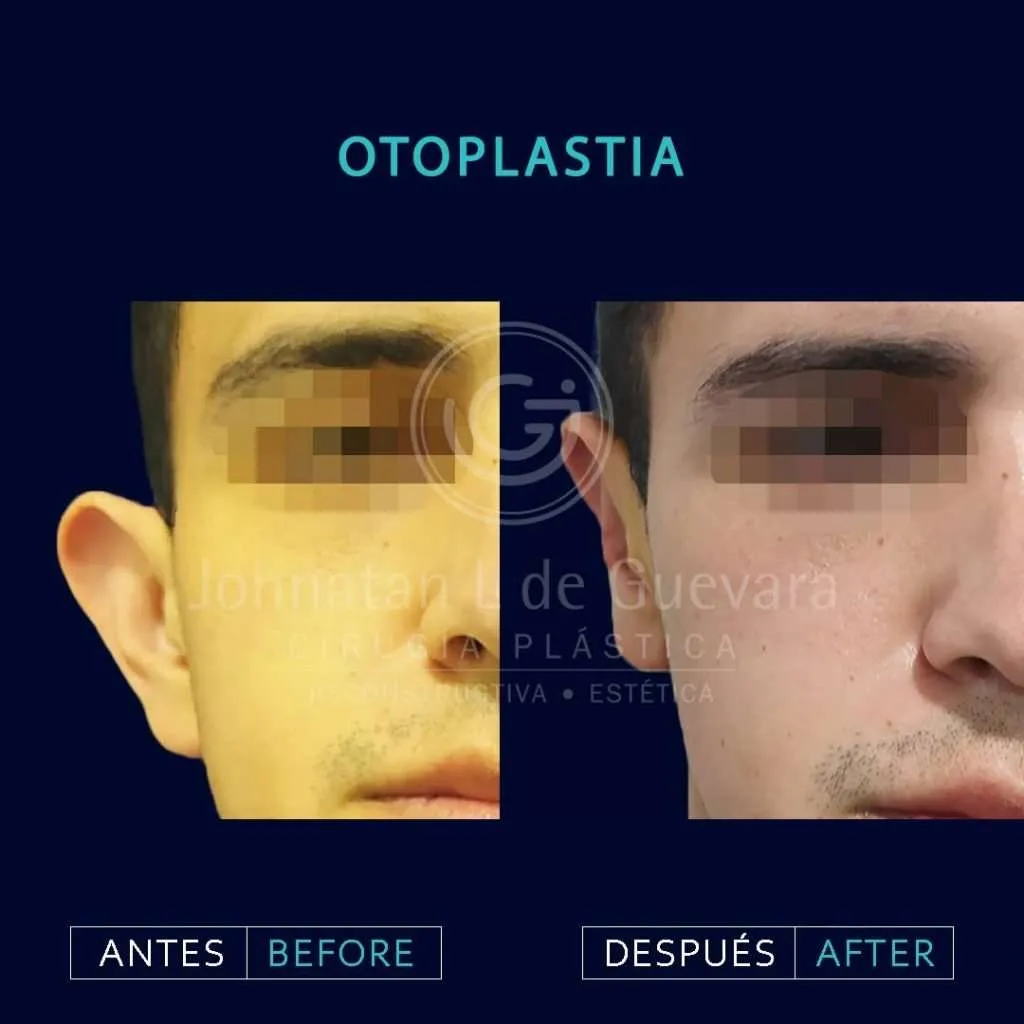 Otoplastia 1