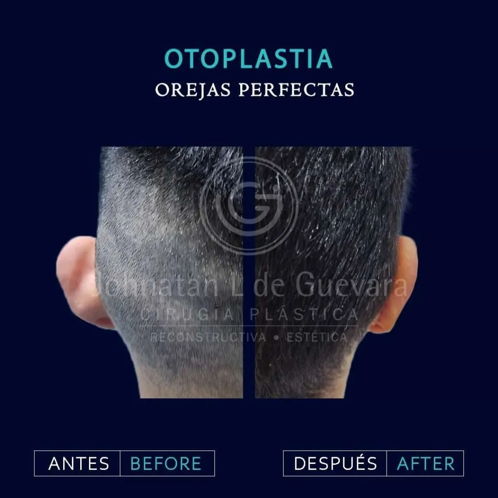 Otoplastia 4