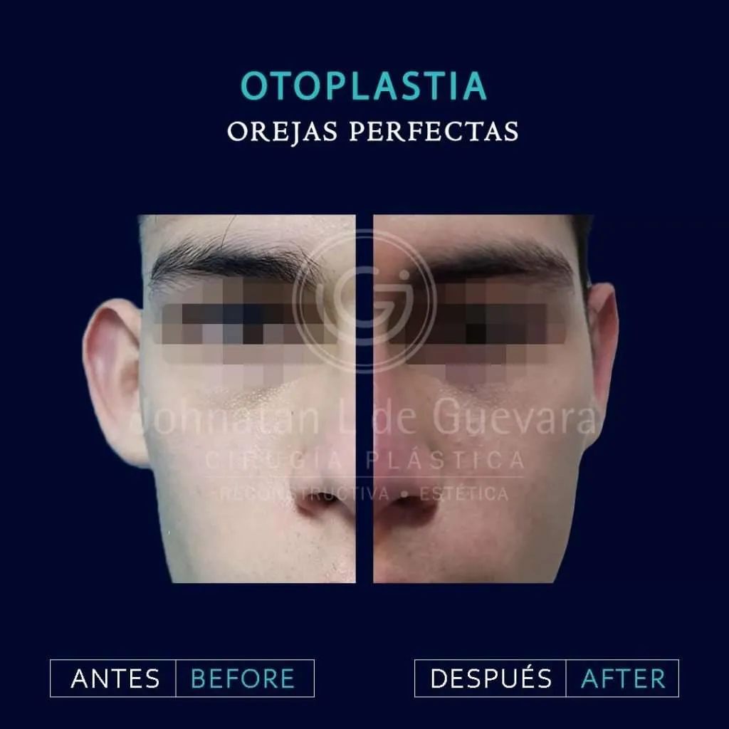Otoplastia 5