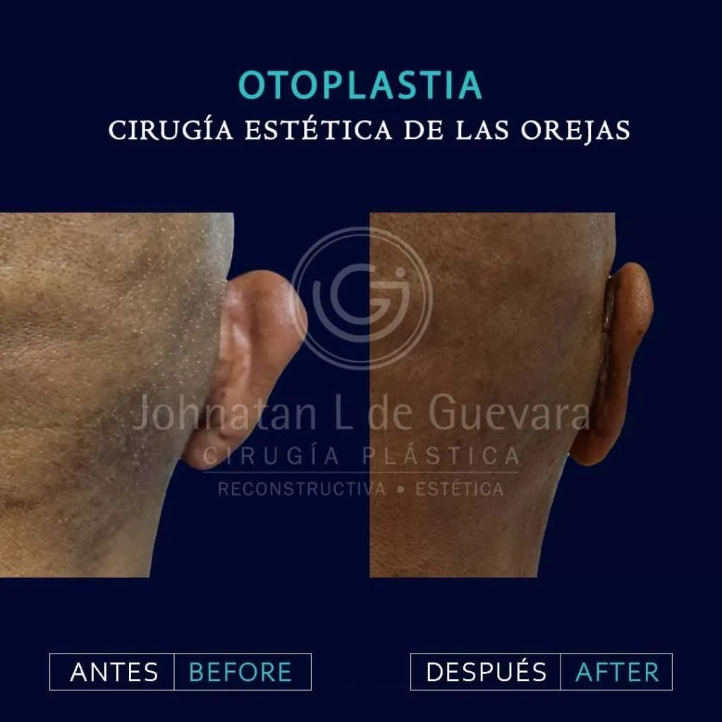 Otoplastia 6