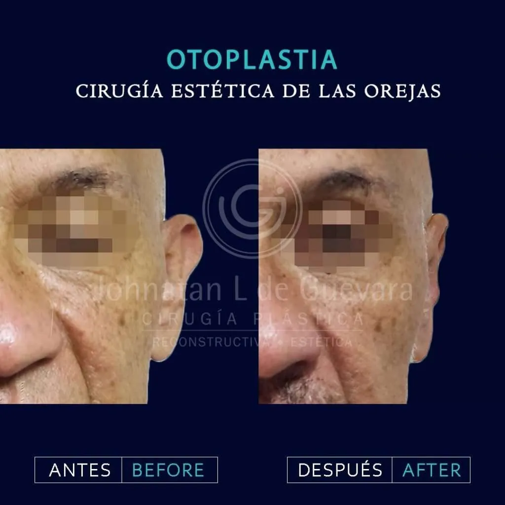Otoplastia 7