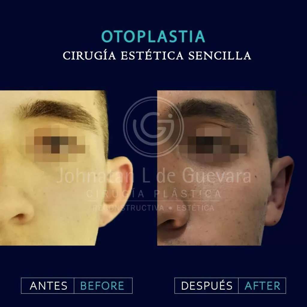 Otoplastia 8