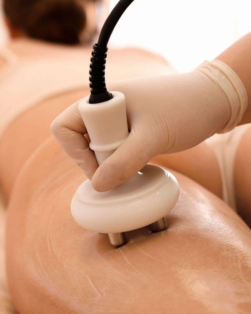 Tratamiento Celulitis A - Cellulite treatment