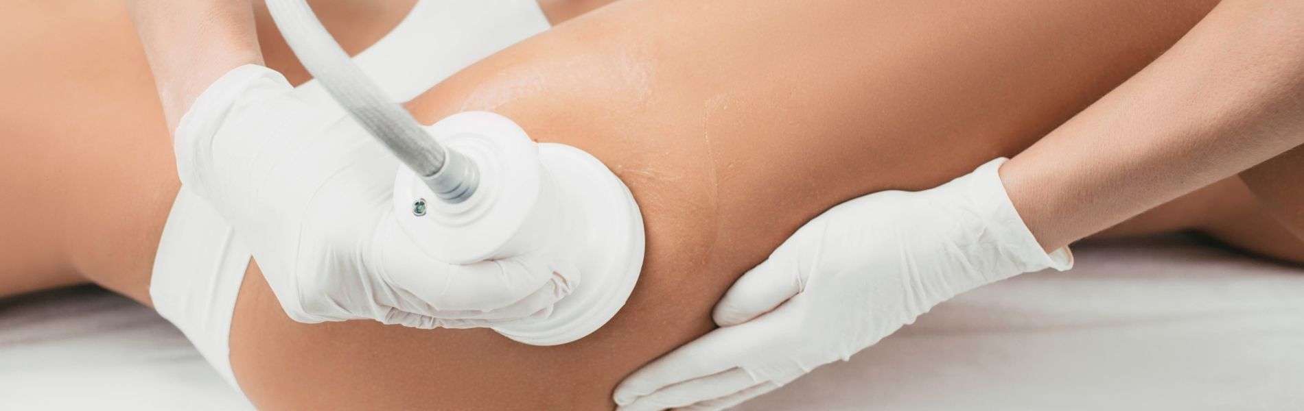 Tratamiento Celulitis E - Cellulite treatment